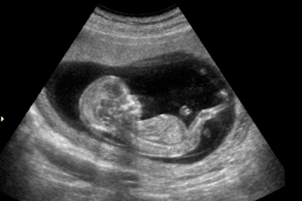 Aborto